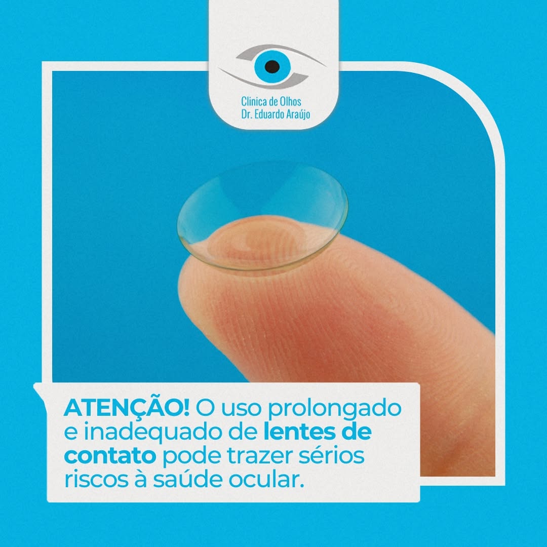 Uso prolongado e inadequado de lentes de contato