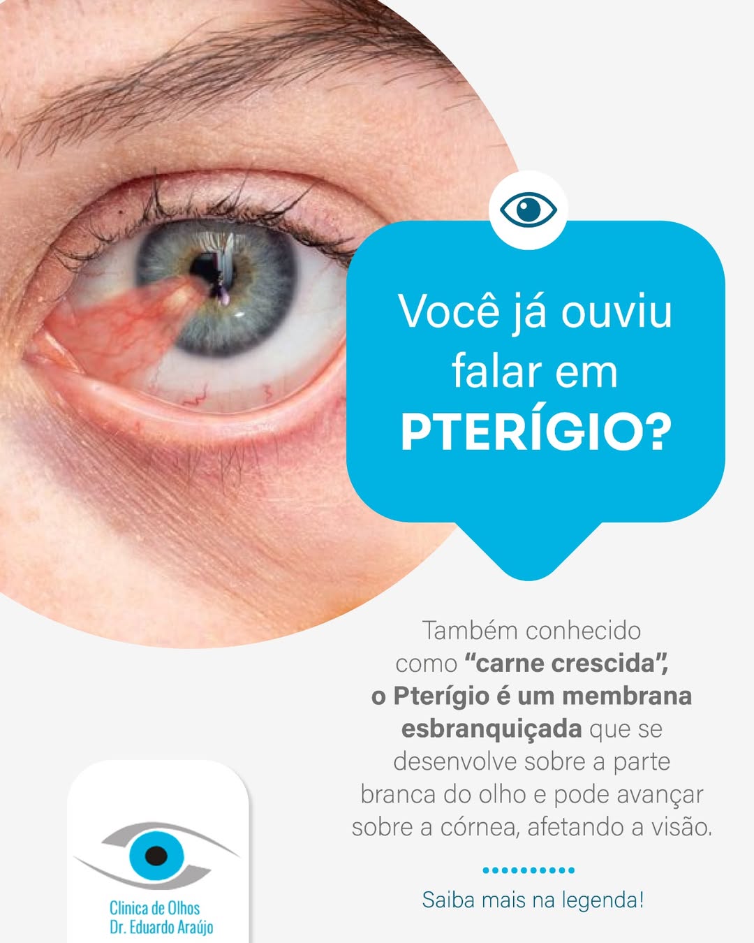 Você ja ouviu falar em PTERÍGIO?